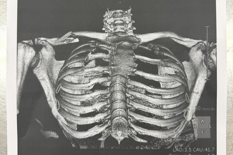 Jorge Martin Minta Saran Dokter ke Marc Marquez