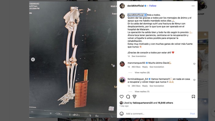 Pebalap Ini Alami Patah Tulang Paha Usai Crash di GP Mandalika