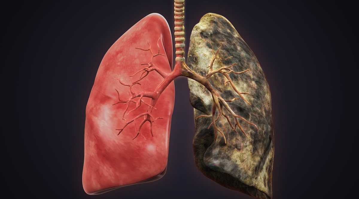 Trump’s Gift To Coal Miners: Less Coal Jobs, More Black Lung Disease
