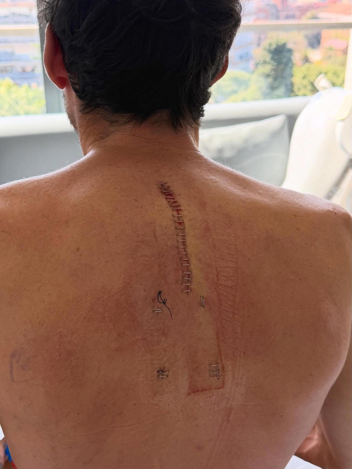 Aleix recibe el alta: “La peor caída de mi carrera”